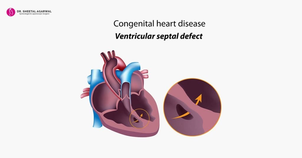 Congenital Heart Defect