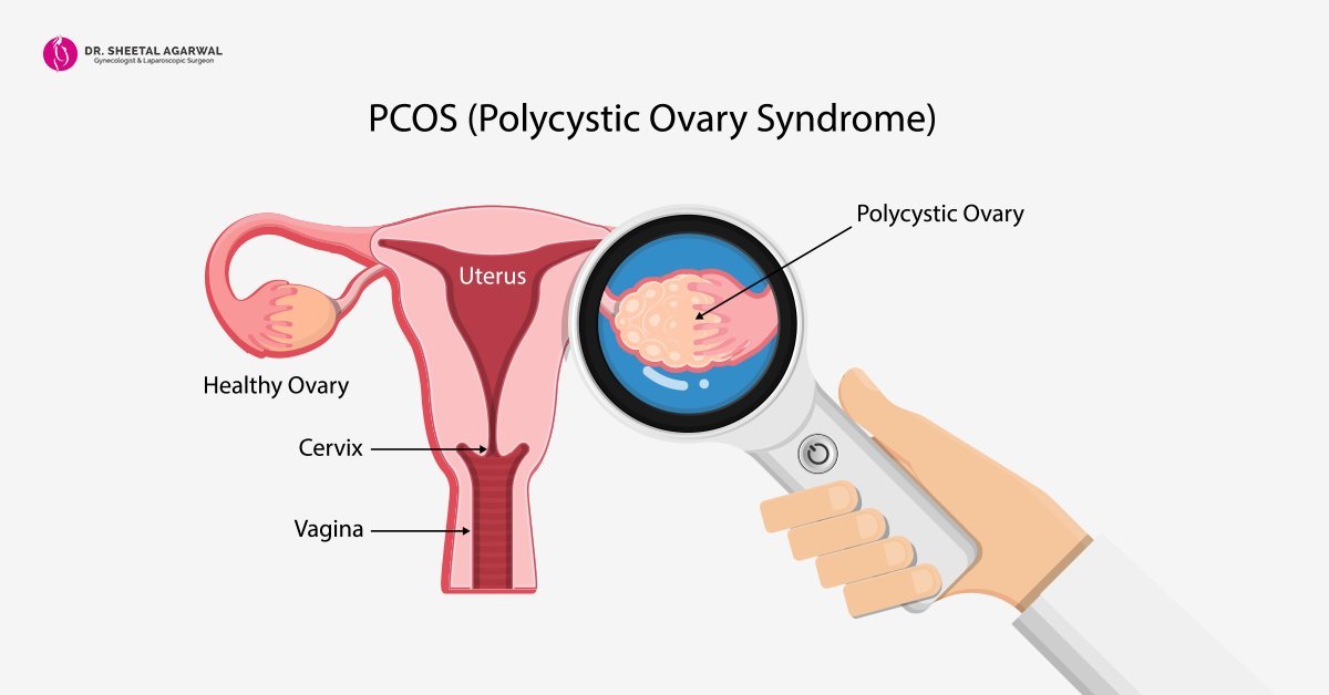 Polycystic-Ovarian-Syndrome