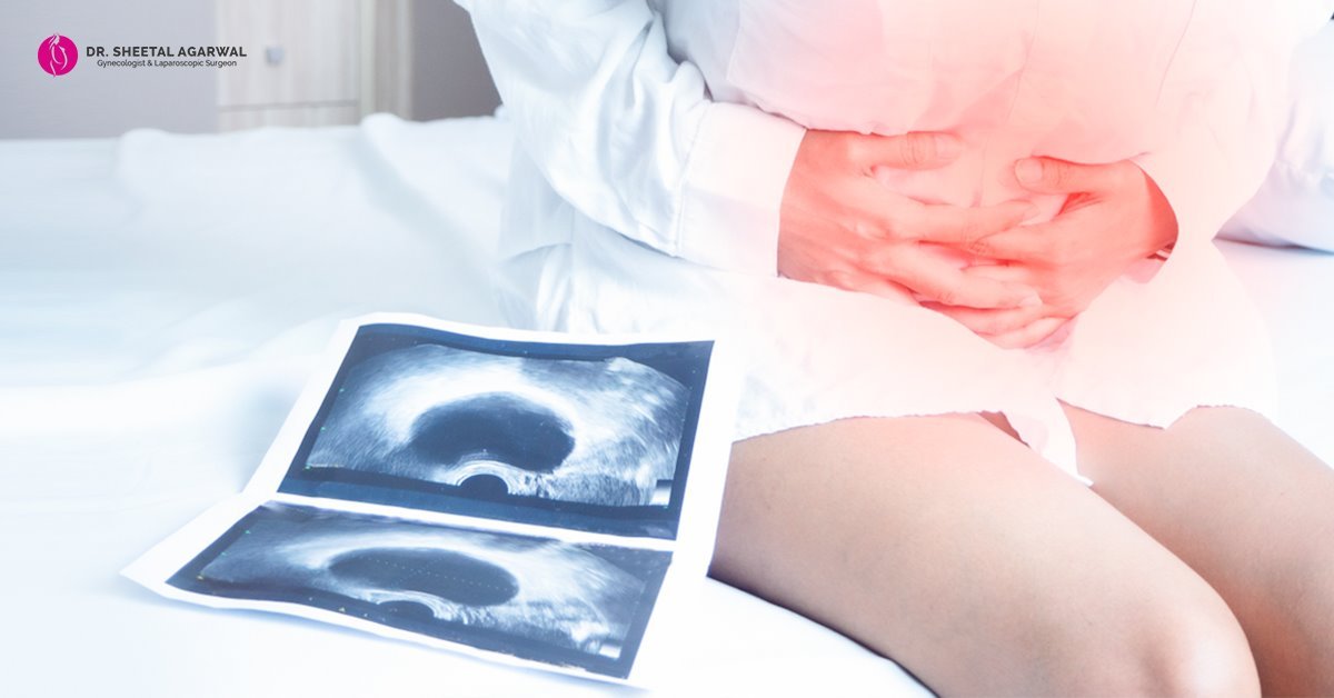7-troublesome-signs-Ovarian-cysts